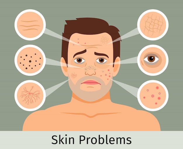 Ilustración de vector de problemas de piel facial masculino. Acné y manchas oscuras, arrugas y círculos debajo de los ojos.