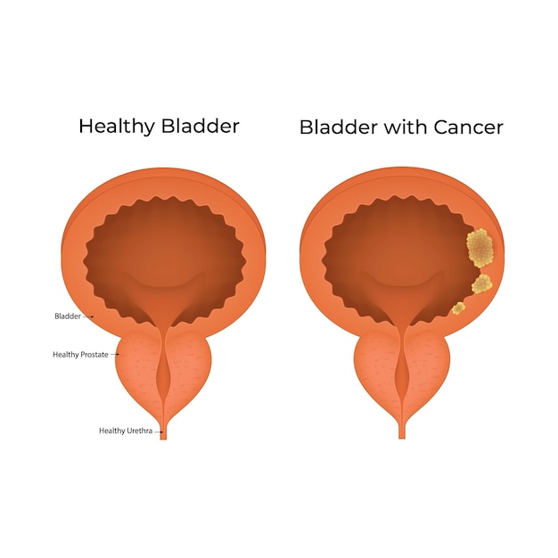 Ilustración del vector de la vejiga saludable y el cáncer