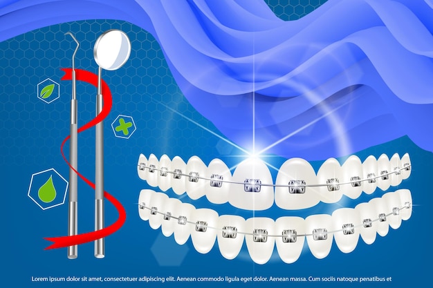 Ilustración vectorial 3D dientes realistas con aparatos ortopédicos alineación de la mandíbula superior e inferior