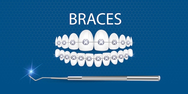 Vector ilustración vectorial 3d de dientes realistas con aparatos ortopédicos alineación de la mordida de los dientes