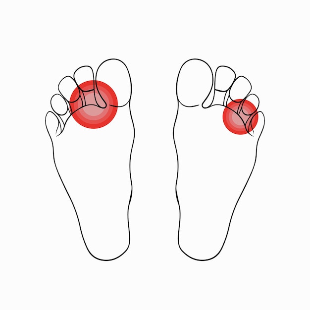 Ilustración vectorial aislada de hongos en los pies dibujo de contorno de hongos en los pies higiene de los pies