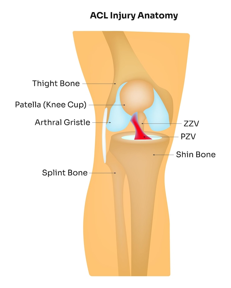 Vector ilustración vectorial de la anatomía de la lesión del lca