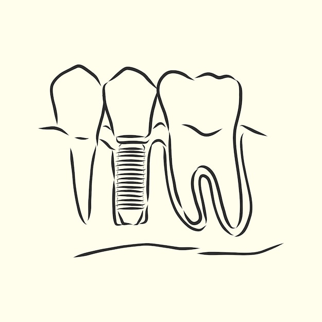 Ilustración vectorial. bocetos, implantes dentales. implante dental, ilustración de dibujo vectorial