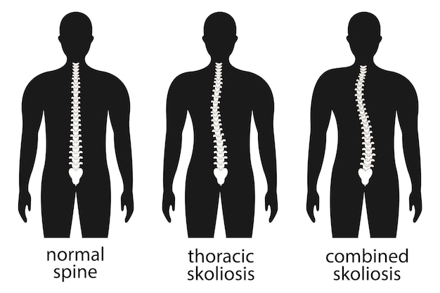 Ilustración vectorial de la deformidad espinal Cifosis lordosis y escoliosis columna infografía cuerpo p