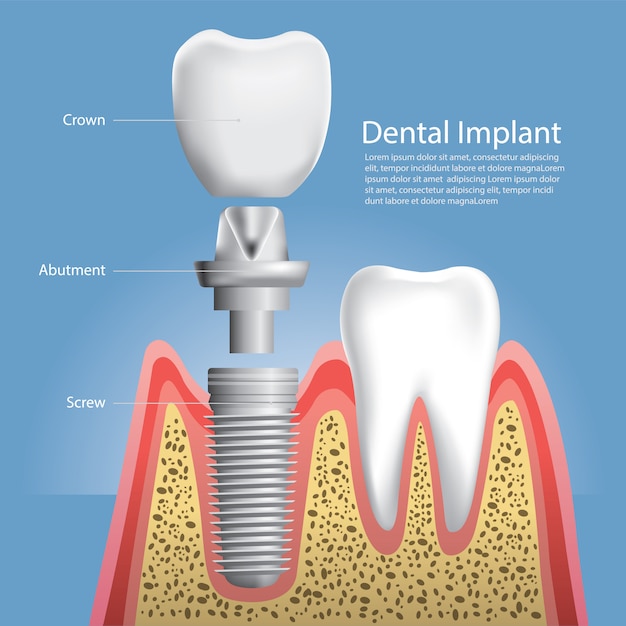 Ilustración vectorial de dientes humanos e implantes dentales