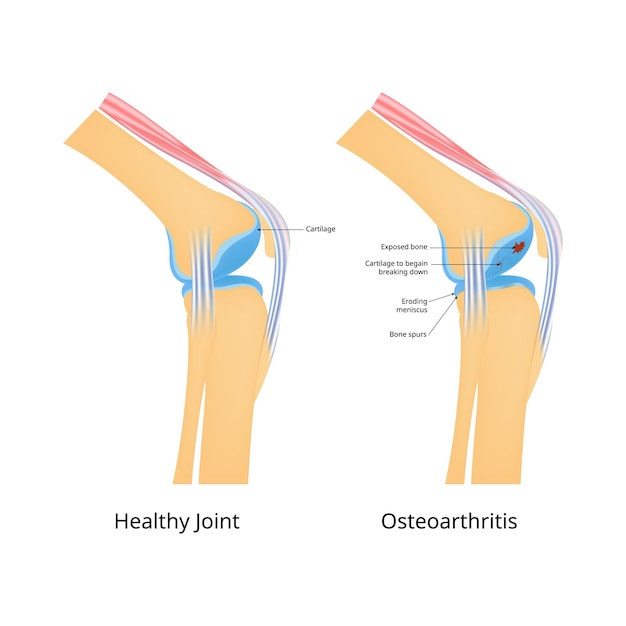 Ilustración vectorial de diseño científico de la osteoartritis