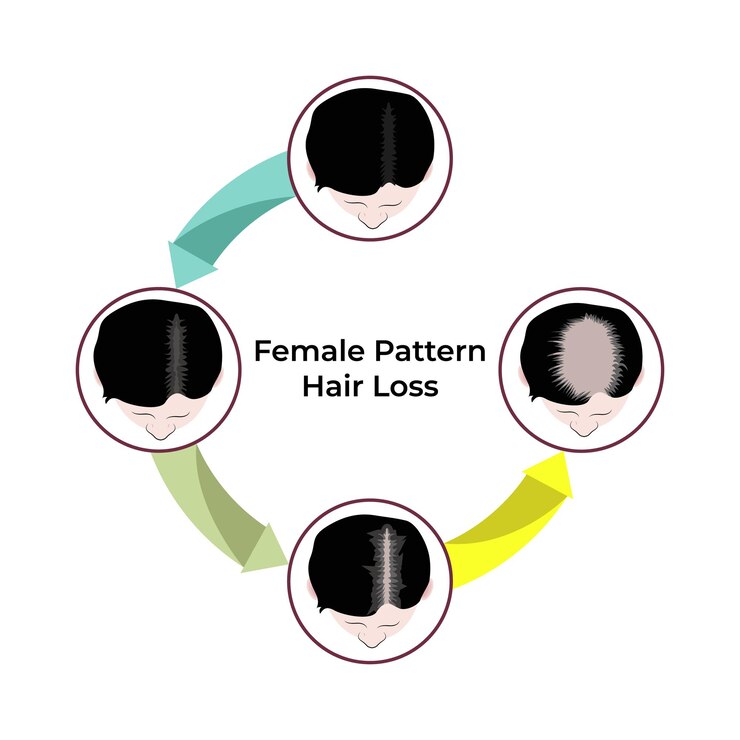 Vector ilustración vectorial de diseño de las etapas de pérdida de cabello de patrón femenino