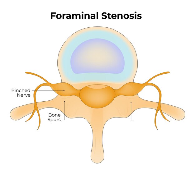 Ilustración vectorial de los espolones óseos del nervio pellizcado de la estenosis foraminal