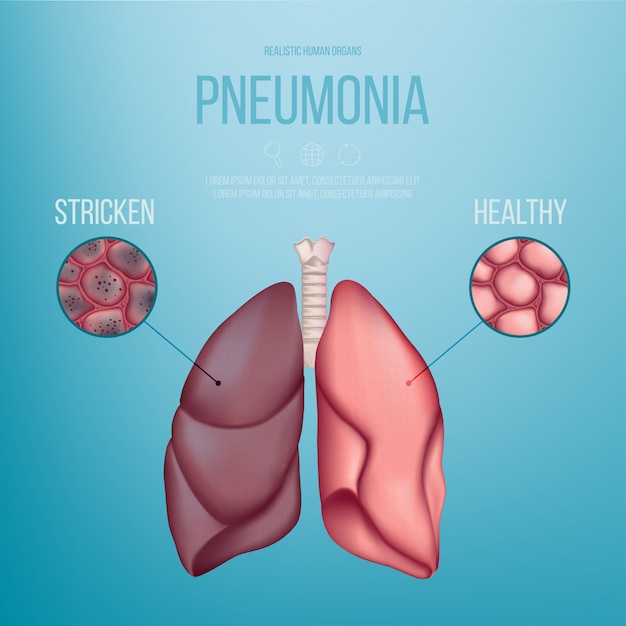 Imagen de un pulmón sano y un pulmón afectado por neumonía. ilustración realista