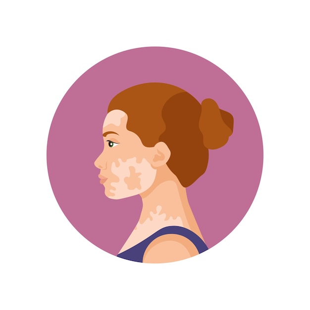 Vector imagen vectorial de una mujer joven con vitíligo