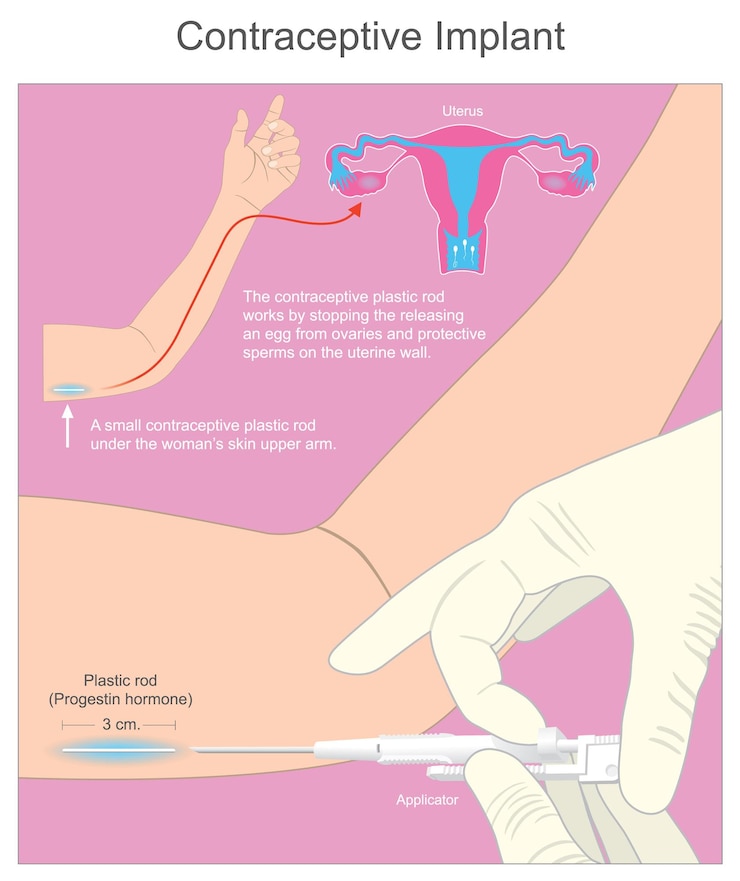 Vector implante anticonceptivo una pequeña varilla plástica anticonceptiva debajo de la piel de la mujer en la parte superior del brazoxa