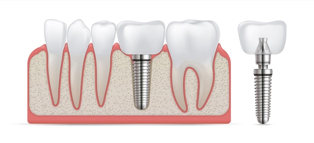 Implante dental Cirugía de cuidado de dientes y fijación de corona Reemplazo de dientes y tratamiento de prótesis Implantación de molar artificial con tornillo de metal Modelo de dentadura Estomatología vectorial