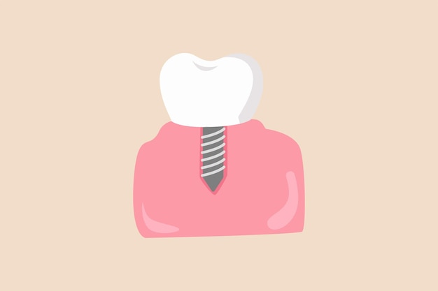 Implante dental concepto de dentista ilustración de vector plano coloreado