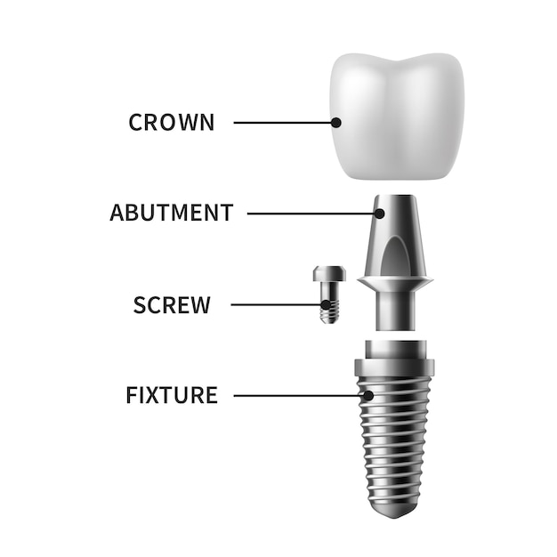 Implante dental. estructura de implante dental realista, corona de modelos pictóricos. afiche infográfico de implantación de ortodoncia de dentaduras postizas de tornillo. prótesis en estomatología clínica vector ilustración aislada