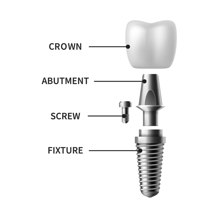 Vector implante dental. estructura de implante dental realista, corona de modelos pictóricos. afiche infográfico de implantación de ortodoncia de dentaduras postizas de tornillo. prótesis en estomatología clínica vector ilustración aislada