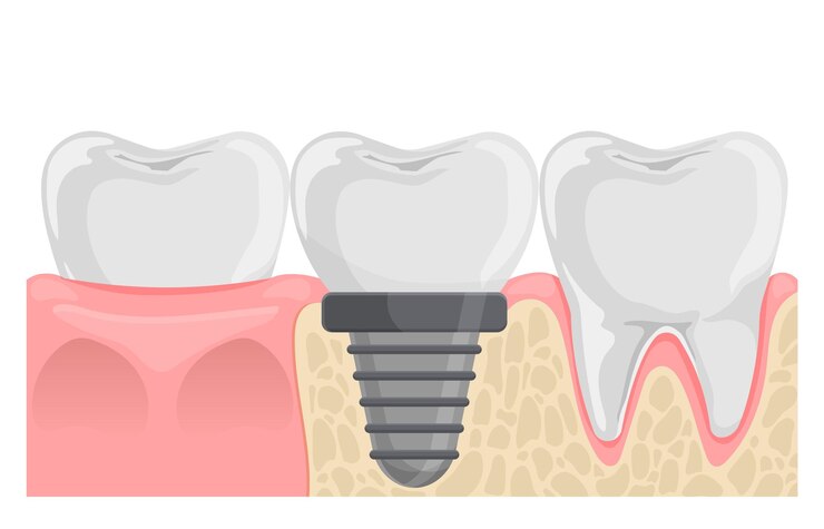 Vector implante dental reemplazo de dientes dientes en la anatomía de las encías ilustración vectorial plana aislada en blanco