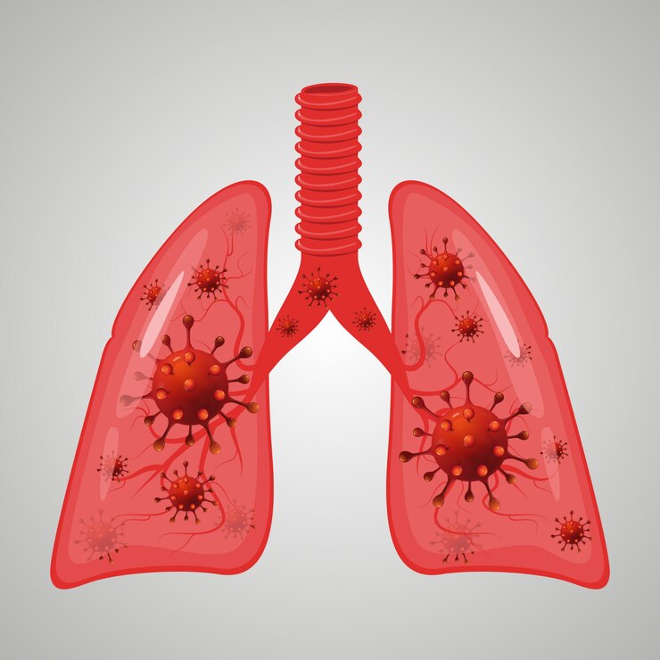 Infección por coronavirus de los pulmones