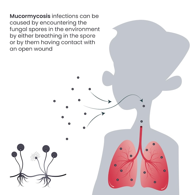 Infección por hongos negros de mucormicosis en los pulmones a través de esporas inhaladas
