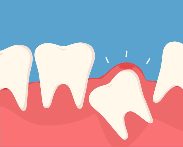 La inflamación del diente debajo de la encía causa dolor en la boca El concepto de cuidado dental Vector