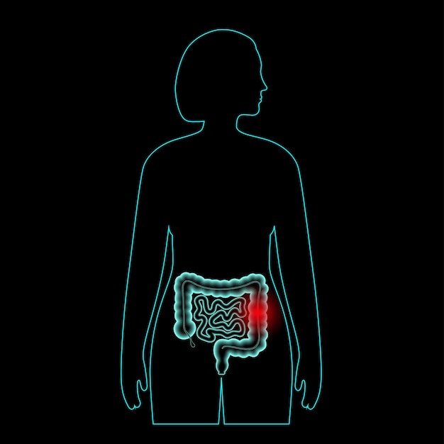 Inflamación y dolor en el intestino humano. Enfermedad inflamatoria intestinal, colitis ulcerosa, infecciones gastrointestinales o cáncer colorrectal. Examen médico de la ilustración de vector 3D de órganos internos