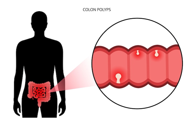 Inflamación de pólipos de colon