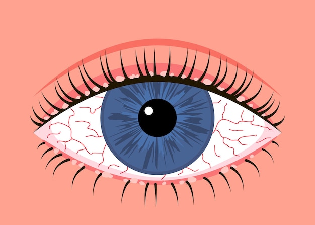 Vector inflamado enfermo ojo humano blefaritis síntoma de alergia venas rojas enfermedad ocular conjuntivitis alérgica