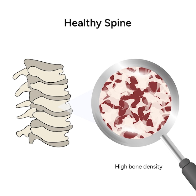 Infografía de alta densidad ósea de columna sana en vector