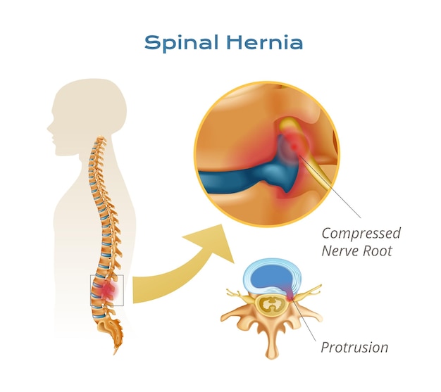 Vector infografía de la anatomía de la médula espinal de las vértebras con la silueta del cuerpo con la columna vertebral y la protuberancia de la raíz nerviosa comprimida vistas ilustración vectorial