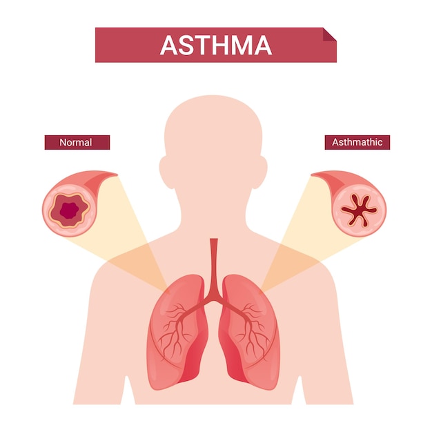 Infografía de asma, concepto de vector de asma humana