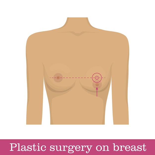 Vector infografía de cirugía plástica de elevación del pezón esquema de corrección quirúrgica de la posición del pezón por método de elevación corrección de la posición de una glándula mamaria en forma de ilustración vectorial