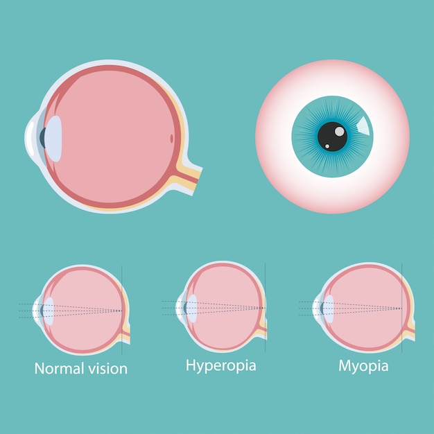 Infografía de defectos oculares