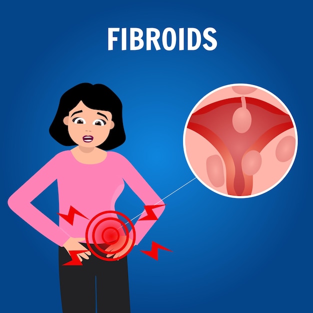 Infografía de fibromas en ilustración vectorial