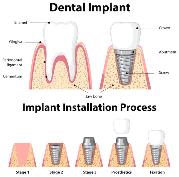 Infografía de humanos en la estructura del implante dental.