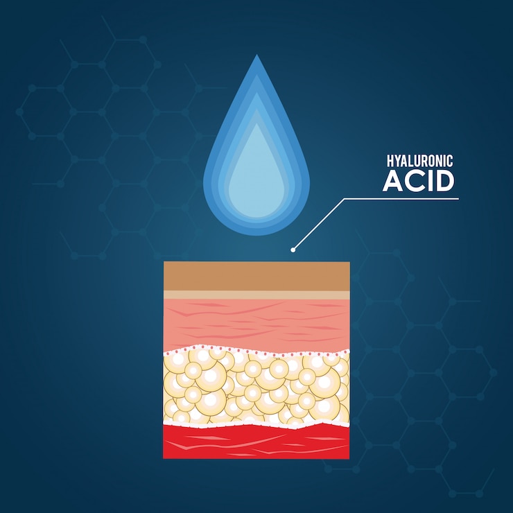 Vector infografía inyección de relleno de ácido hialurónico