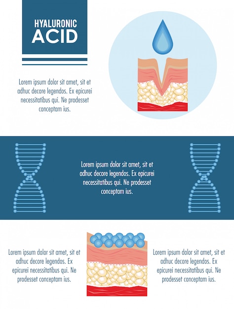 Infografía inyección de relleno de ácido hialurónico