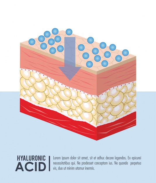Infografía inyección de relleno de ácido hialurónico