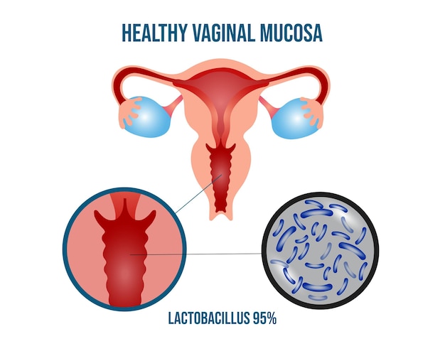 Vector infografía de lactobacilos de la mucosa vaginal sana en ilustración vectorial