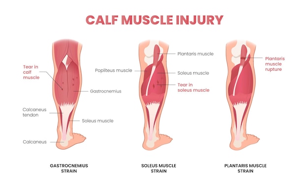 Infografía de lesiones musculares en la pantorrilla