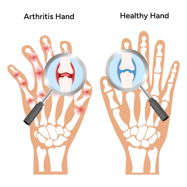 Vector infografía médica de la artritis reumatoide en las articulaciones