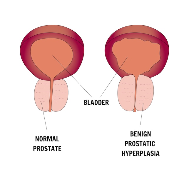 Infografía médica con enfermedad del problema de la próstata masculina