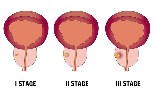 Infografía médica con problema de próstata masculino