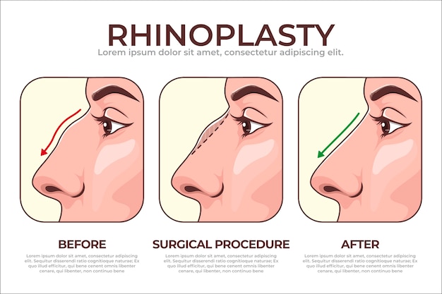 Vector infografía de rinoplastia dibujada a mano