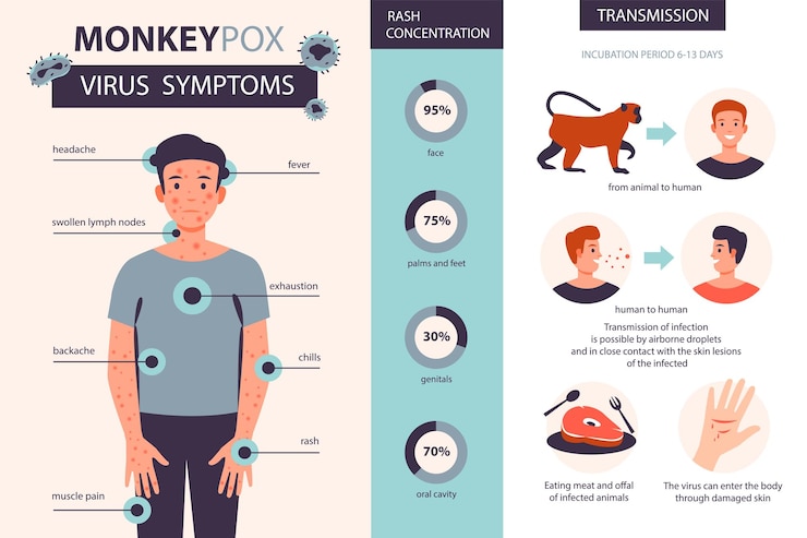 Vector infografía de los síntomas del virus de la viruela del mono causa infecciones cutáneas erupción febril con dolor de cabeza