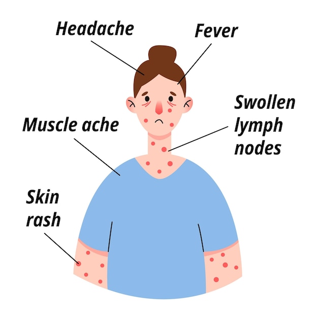 Infografía de síntomas del virus de la viruela del mono en pacientes con fiebre, dolor de cabeza, erupciones de ganglios linfáticos inflamados en la cara, cuerpo y dolores musculares en la espalda