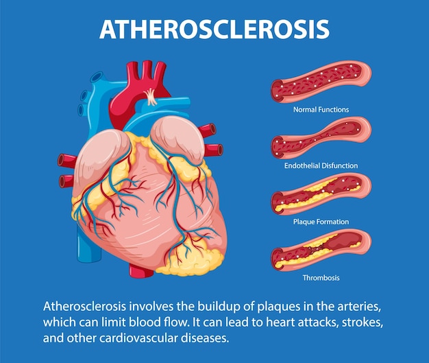 Infografía sobre anatomía humana y aterosclerosis en educación científica
