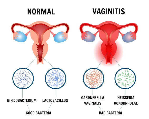 Vector infografía de vaginitis normal en ilustración vectorial