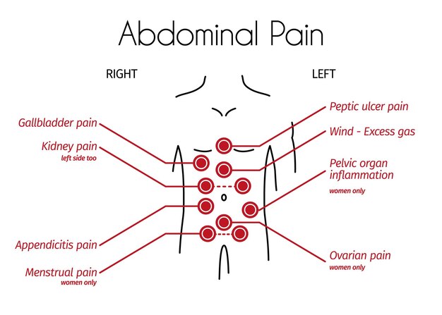 Infografía vectorial de tipos de dolor abdominal