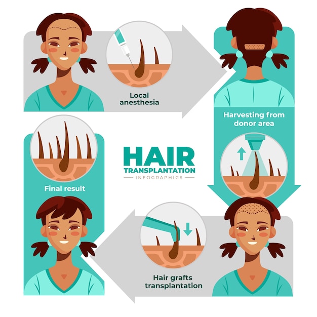 Infografías de dibujos animados planos de trasplante de cabello