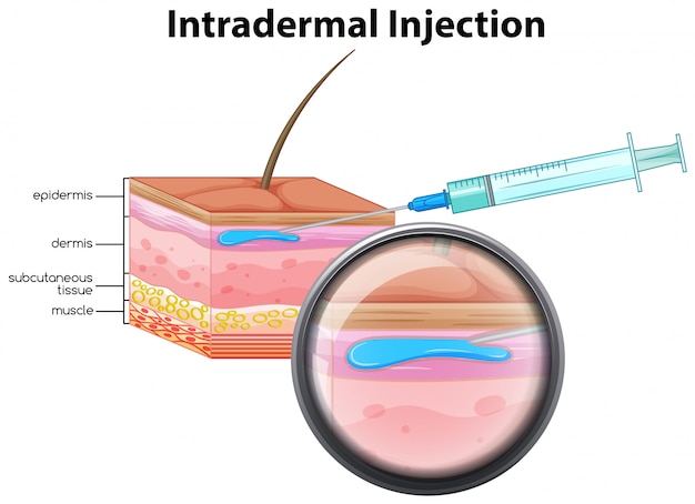 Inyección intradérmica en el fondo blanco