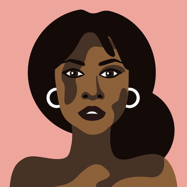 Joven hermosa mujer mulata con el vector de la enfermedad de la piel del vitiligo